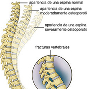 Cada 30 segundos se produce una fractura por osteoporosis