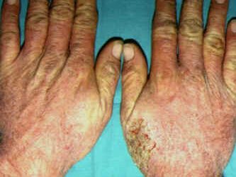 eczema_cronico_manos