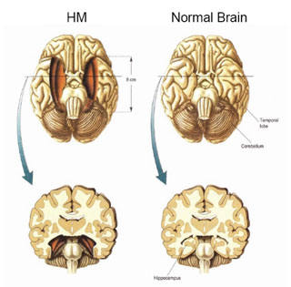 cerebro_molaison