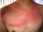 psoriasis_2