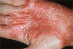 psoriasis_mano