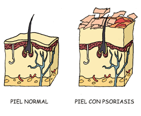 psoriasis_piel