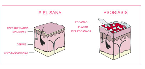 psoriasis