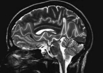 epilepsia_prsalud_prnoticias