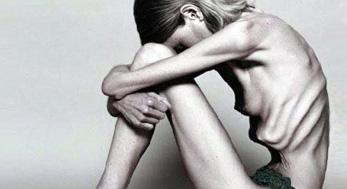 Anorexia1
