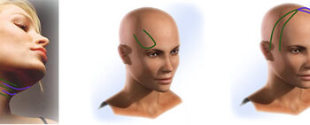 ClnicaMenorca_3GenHilos