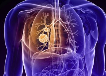Comienza un estudio de Fase III para cáncer microcítico de pulmón en segunda línea