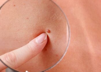 cancer de piel y la fundacion piel sana de dermatologia