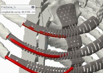 Diseñan e implantan una prótesis biomecánica torácica impresa en 3D