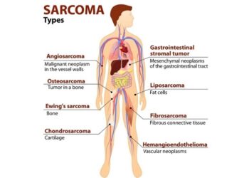 sarcoma diagnostico y tratamiento