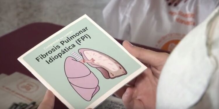 Fibrosis Pulmonar Idiopática. FOTO: Youtube.