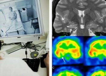 Un estudio advierte de los riesgos de retirar la medicación en una Epilepsia poco diagnosticada