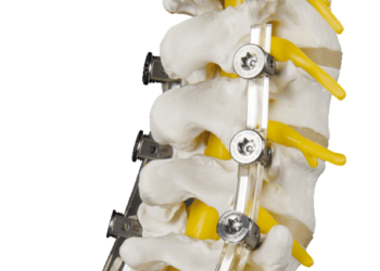 SpineShape, el implante de columna que se adapta a la patología del paciente