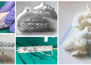 HM Hospitales, pioneros en España en realizar una intervención de un aneurisma de arco aórtico con ayuda de una impresión 3D