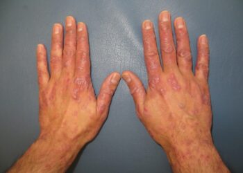 Los pacientes con psoriasis que se encuentren en tratamiento biológico o sistémico podrán seguir usándolo durante la pandemia