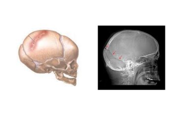 Aumentan los traumatismos craneoencefálicos por caídas