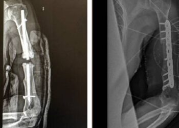 El Hospital Universitario General de Villalba realiza una innovadora intervención basada en la planificación quirúrgica tridimensional