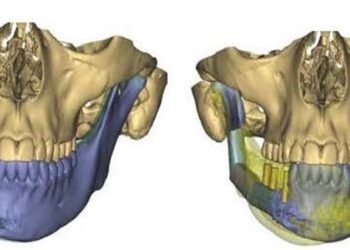 Recuperar la dentición tras un cáncer de cavidad oral