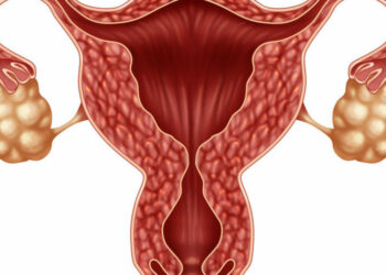 Síndrome de Ovarios Poliquísticos (SOP): ¿cómo reconocerlo y tratarlo?