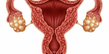 Síndrome de Ovarios Poliquísticos (SOP): ¿cómo reconocerlo y tratarlo?