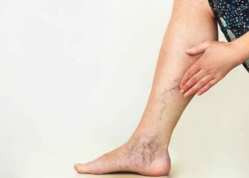 Varices, más que una preocupación estética