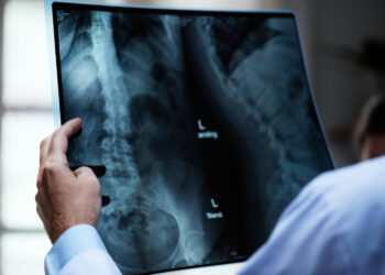 Osteoporosis: la enfermedad que afecta a más de 2,8 millones de personas