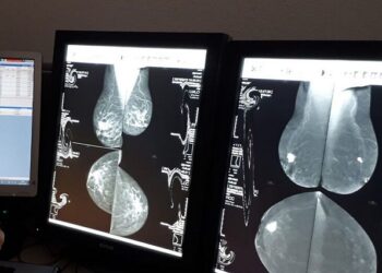 El 50% de las mujeres experimentan un falso positivo de cáncer de mama tras la mamografía