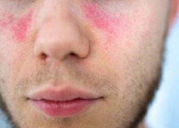 Pacientes y profesionales reclaman un abordaje más temprano del lupus