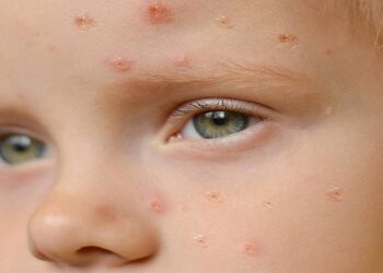 España confirma al menos un caso de viruela del mono en un menor de 3 años