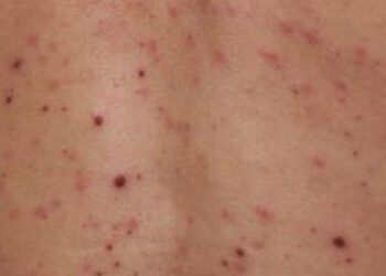 Europa roza los 18.000 casos de viruela del mono