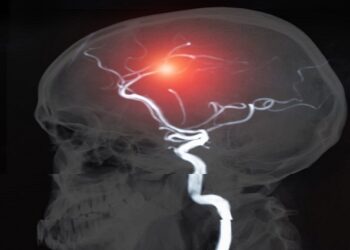 La mortalidad por ictus ha disminuido gracias a la detección precoz y al control de los factores de riesgo