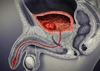 El cáncer de vejiga es el séptimo tumor diagnosticado en todo el mundo