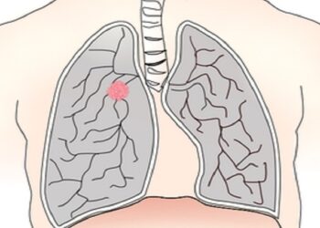El IIS-FJD aboga por conocer la efectividad del tratamiento para cáncer de pulmón