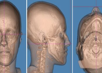 Cirugía ortognática: la solución para la corrección de asimetrías faciales