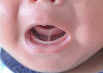 Expertos alertan del aumento de las cirugías de frenillo lingual innecesarias
