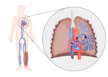 Procedimientos innovadores para el tromboembolismo pulmonar