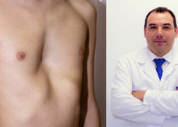 Tórax excavado, una deformidad congénita de la pared torácica