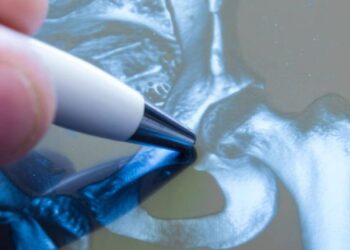 Protocolo de tratamiento quirúrgico precoz de las fracturas de cadera osteoporóticas