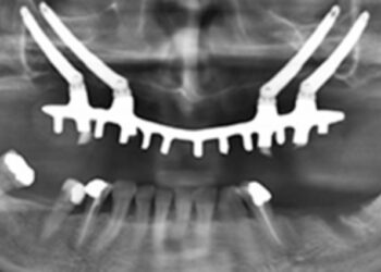 Implantes dentales y limitaciones óseas: soluciones que plantean los especialistas