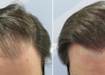 Nueva técnica de trasplante capilar de pelo largo y sin rasurado