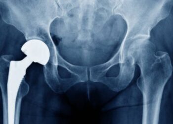 La Fiscalía pide al Estado que responda por los daños de las prótesis de cadera defectuosas BHR