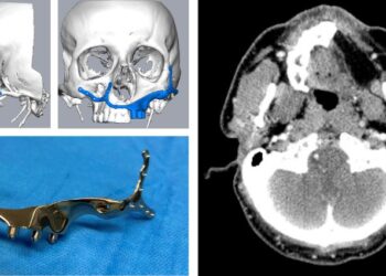 El Hospital Rey Juan Carlos realiza una reconstrucción maxilar de secuela oncológica