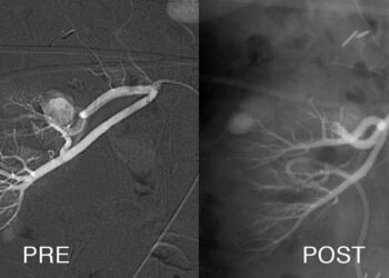 Aneurismas viscerales: opciones terapéuticas para los pacientes