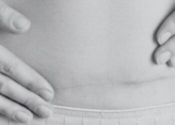 El Hospital Ruber Internacional, pionero en el uso de la tecnología láser en cesáreas para mejorar la cicatrización y el bienestar estético de las pacientes