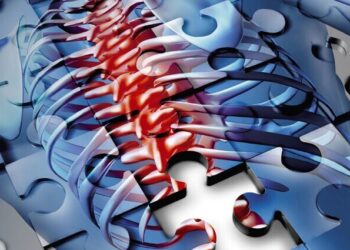 La nueva generación de implantes dinámicos: tratamiento menos agresivo para la estenosis de canal lumbar