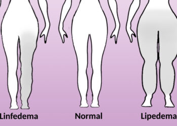 Lipedema y linfedema, dos enfermedades con síntomas parecidos, pero tratamientos distintos