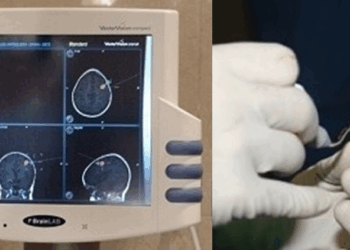 Neuronavegación para tratar con mayor precisión los tumores cerebrales y la estenosis lumbar