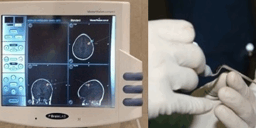 Neuronavegación para tratar con mayor precisión los tumores cerebrales y la estenosis lumbar