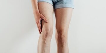 La salud venosa, un factor determinante en la prevención de las varices