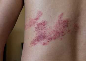 ‘La espina invisible’, la campaña que sensibiliza sobre el herpes zóster a través de una rosa simbólica